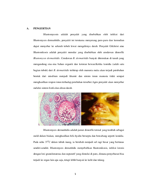 Blastomycosis in humans lungs image