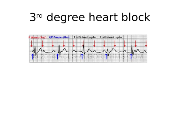 (PPT) 3rd degree heart block