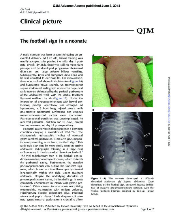 (PDF) The football sign in a neonate