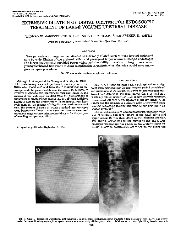 (PDF) Extensive Dilation of Distal Ureter for Endoscopic Treatment of