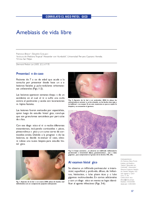 Symptoms of amebiasis image