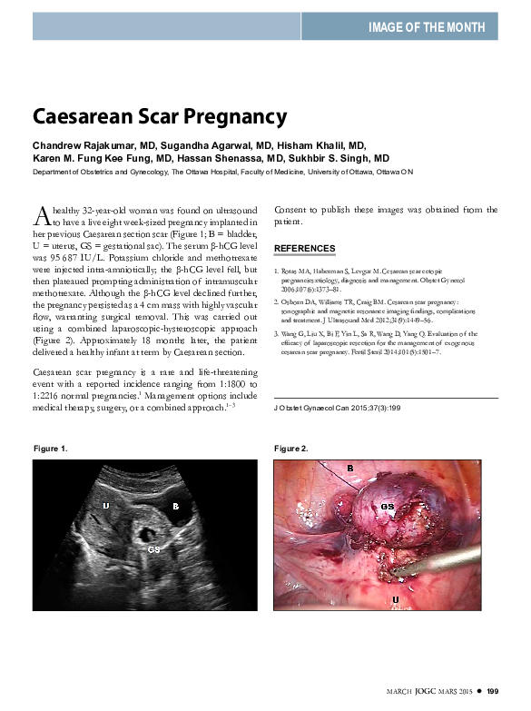 (PDF) Caesarean scar pregnancy Hassan Shenassa and Chandrew Rajakumar