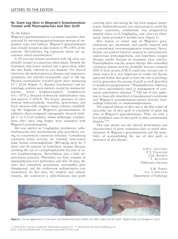(PDF) Re: Giant Leg Ulcer in Wegener's Granulomatosis Treated with ...