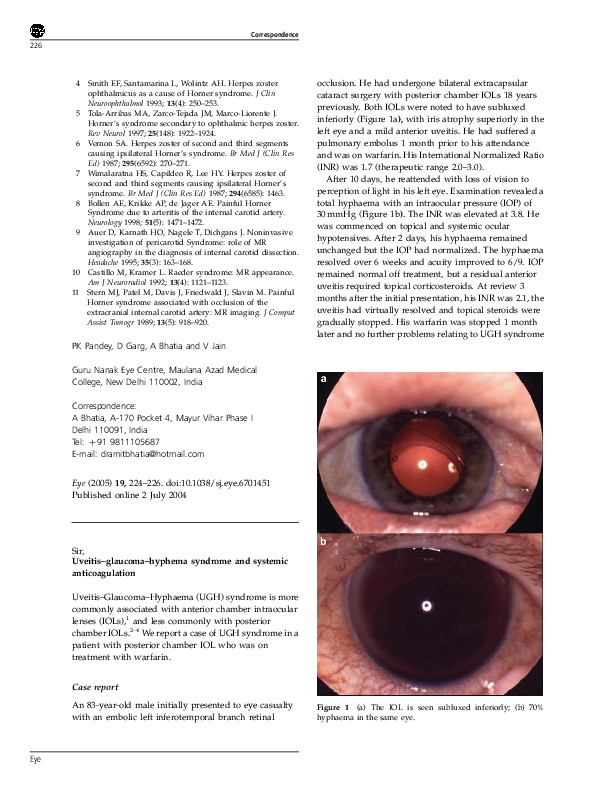 Uveitic Glaucoma Hyphema