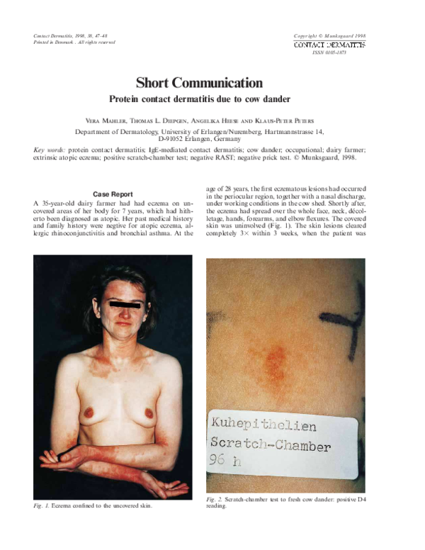 (PDF) Protein contact dermatitis due to cow dander