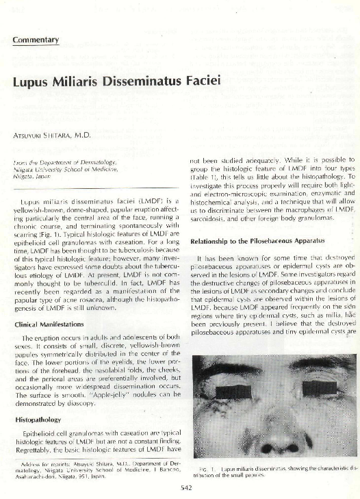 Lupus Miliaris Disseminatus Faciei 治療 – BZWBYG