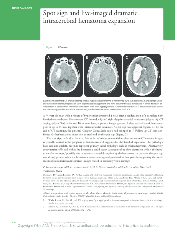 (PDF) Spot sign and live-imaged dramatic intracerebral hematoma expansion