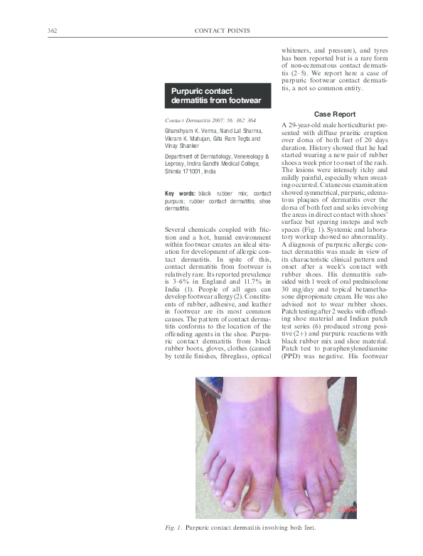 (PDF) Purpuric contact dermatitis from footwear Vikram Mahajan