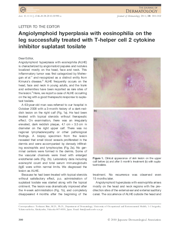 (PDF) Angiolymphoid hyperplasia with eosinophilia treated with isotretinoin
