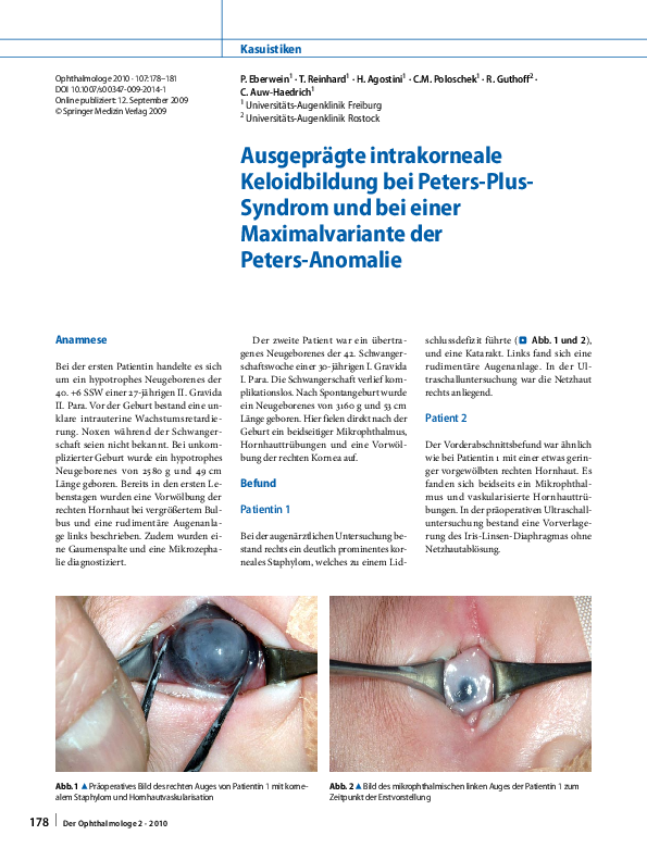 (PDF) Ausgeprägte intrakorneale Keloidbildung bei Peters-Plus-Syndrom ...