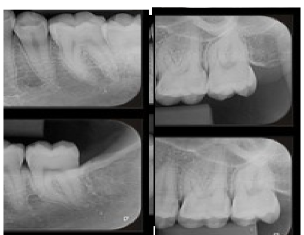 (DOC) ESTRUCTURAS NORMALES OBSERVABLES EN LAS RADIOGRAFÍAS PERIAPICALES