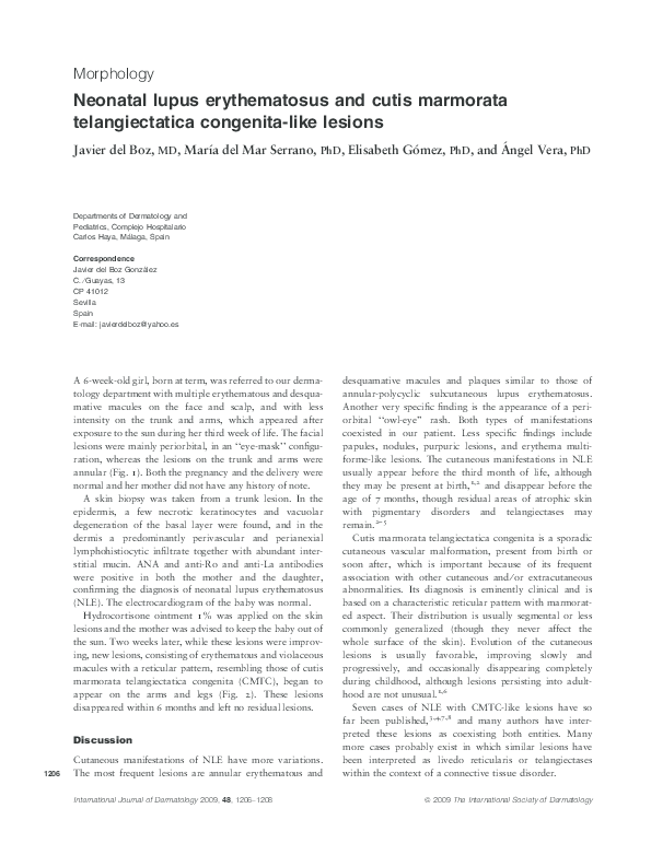 Pdf Neonatal Lupus Erythematosus And Cutis Marmorata Telangiectatica Congenita Like Lesions Angel E Vera L Academia Edu