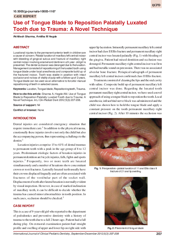(PDF) Use of Tongue Blade to Reposition Palatally Luxated Tooth due to