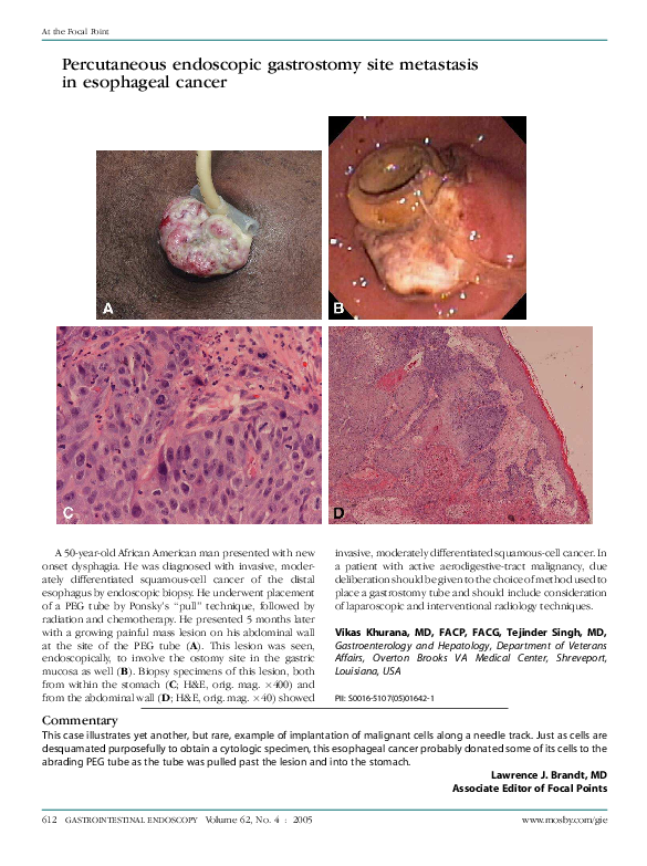 (PDF) Percutaneous endoscopic gastrostomy site metastases in head and