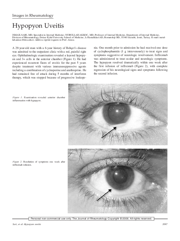(PDF) Hypopyon Uveitis in Ankylosing Spondylitis