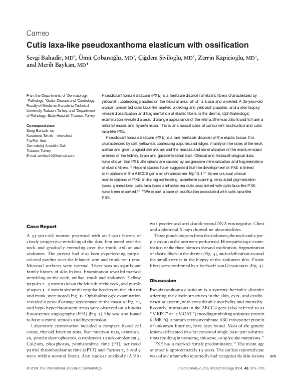(PDF) Epidermolysis bullosa acquisita associated with vitiligo, Graves ...