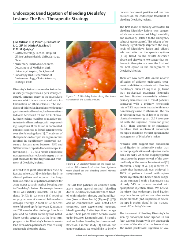 pdf-endoscopic-band-ligation-of-bleeding-dieulafoy-lesions-the-best