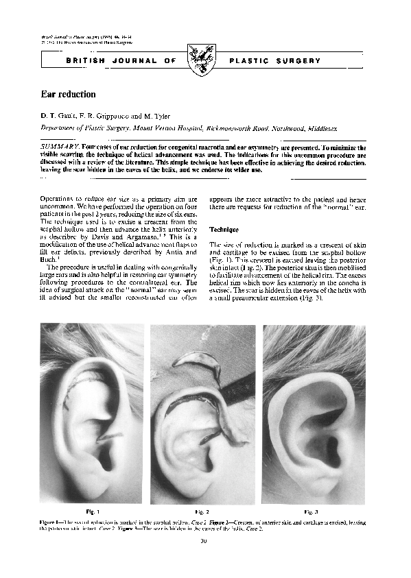 (PDF) Ear reduction