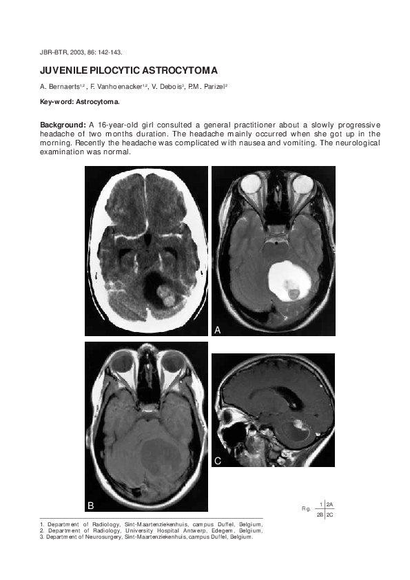 (PDF) Juvenile pilocytic astrocytoma