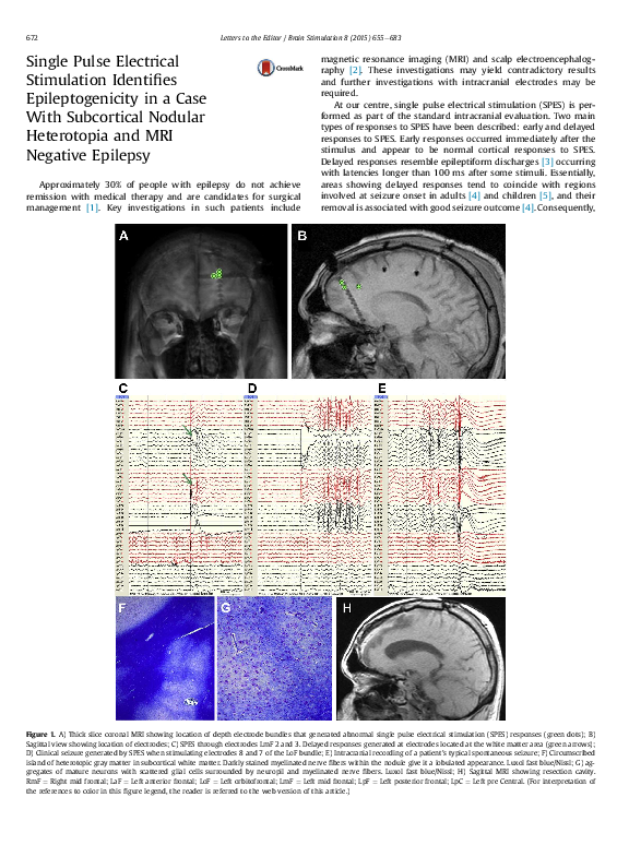 (PDF) Single Pulse Electrical Stimulation Identifies Epileptogenicity ...