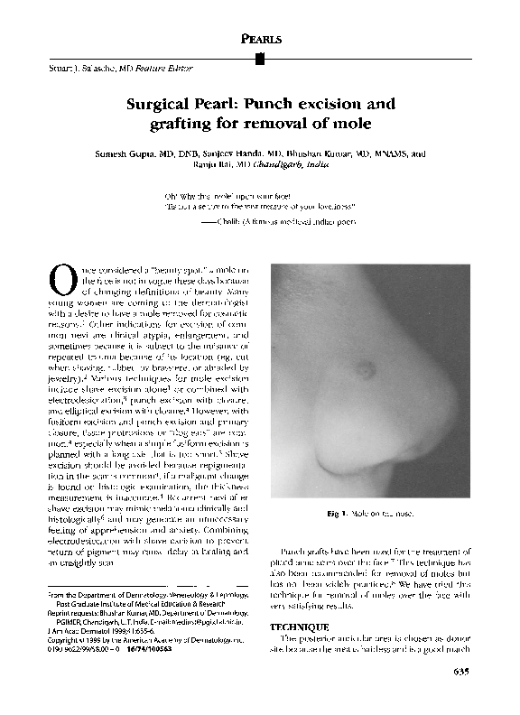 (PDF) Surgical Pearl Punch excision and grafting for removal of mole