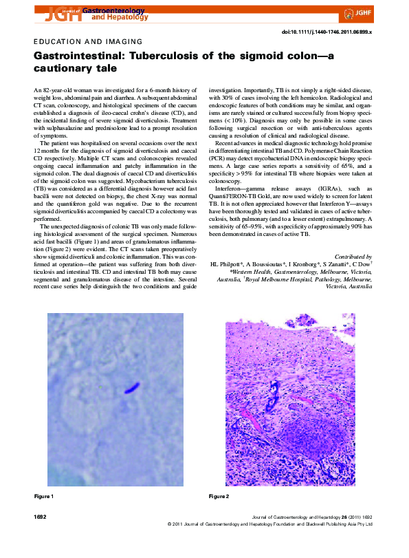 (PDF) Gastrointestinal: Tuberculosis of the sigmoid colon-a cautionary tale