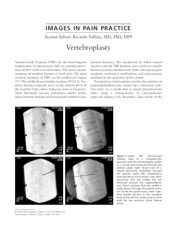 Pdf Vertebroplasty