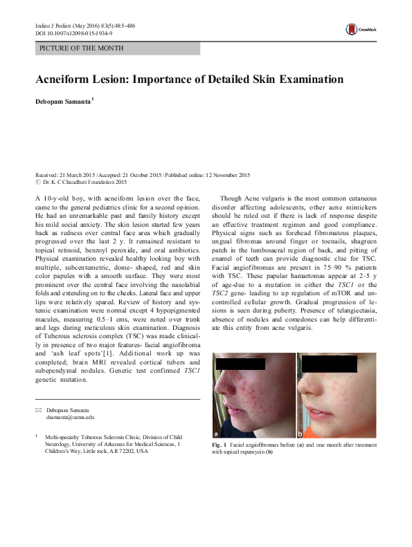 (PDF) Acneiform Lesion: Importance of Detailed Skin Examination