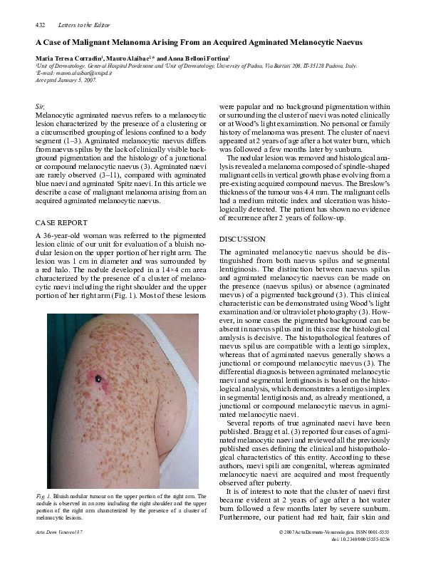 (PDF) A Case of Malignant Melanoma Arising From an Acquired Agminated ...