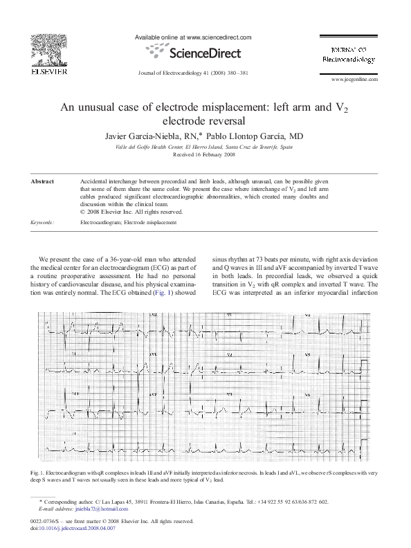 (PDF) An unusual case of electrode misplacement left arm and V2