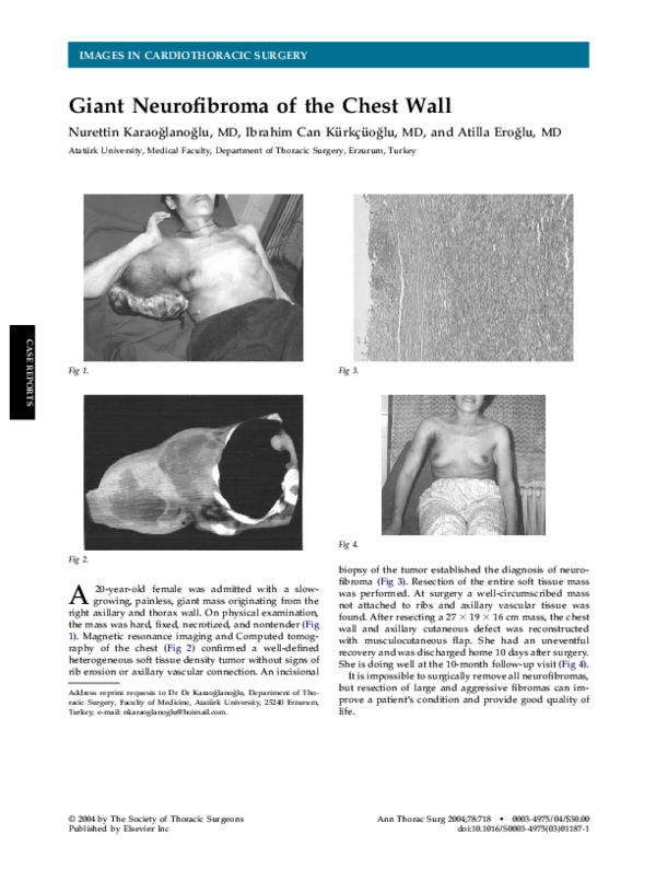 (PDF) Giant neurofibroma of the chest wall Domenico Galetta
