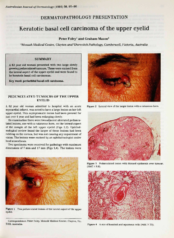 (PDF) Keratotic basal cell carcinoma of the upper eyelid Peter Foley
