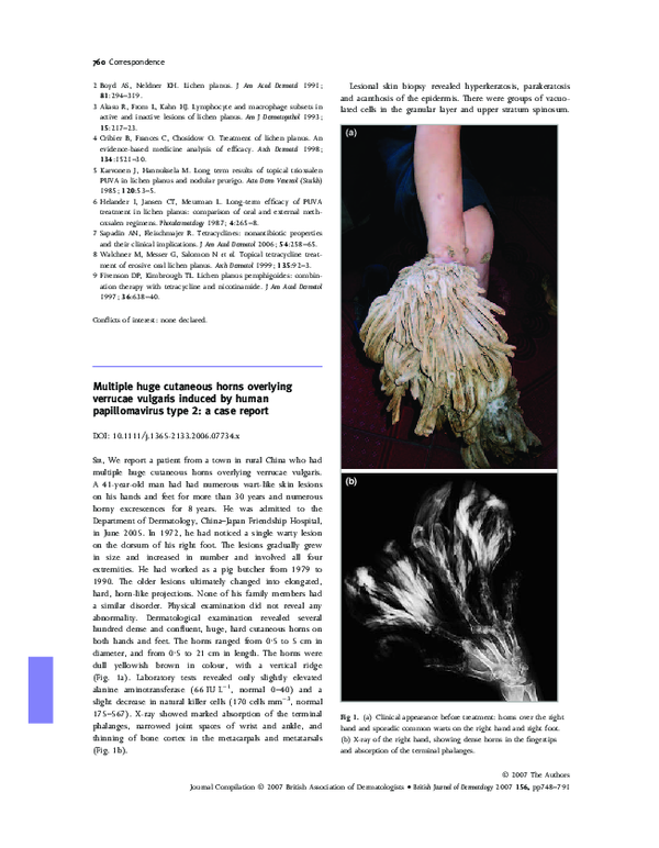 (PDF) Multiple huge cutaneous horns overlying verrucae vulgaris induced ...