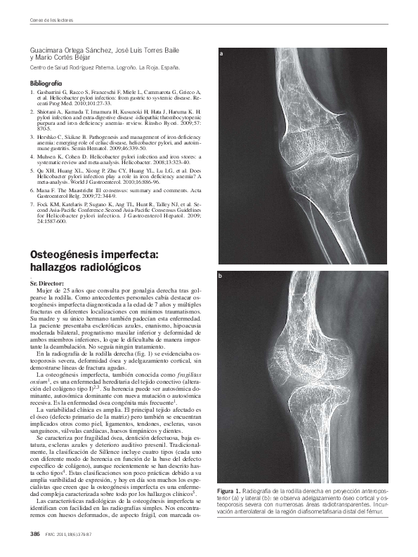 All about osteogenesis imperfecta picture