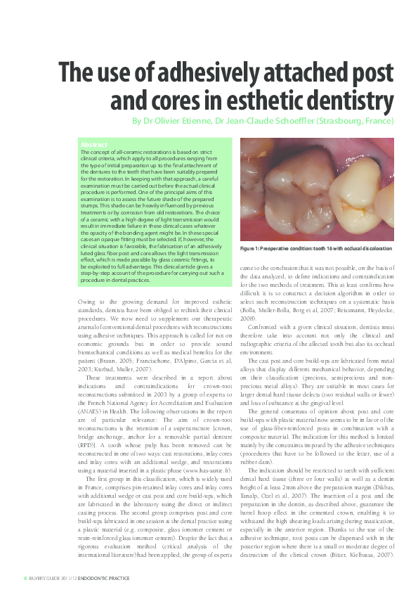 (PDF) The use of adhesively attached post and cores in esthetic dentistry