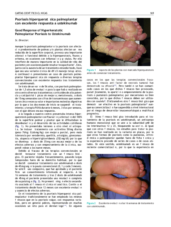Psoriasis pustular de palmas y plantas
