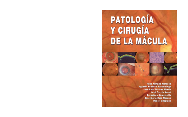 síntomas de tracción vitreorretiniana de diabetes