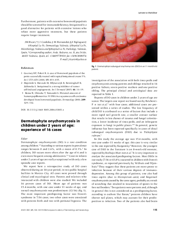 Onychomycosis treatment with vinegar image