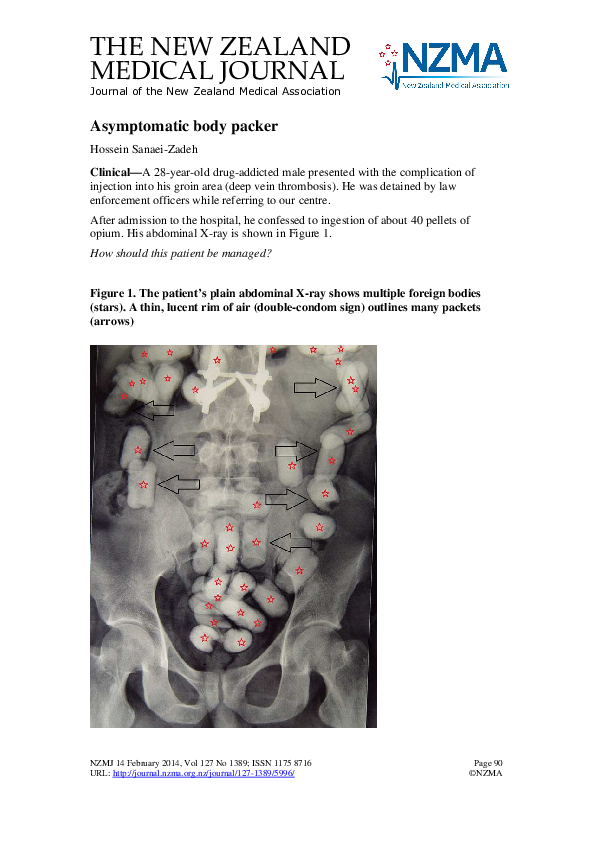 (PDF) Medical image. Asymptomatic body packer