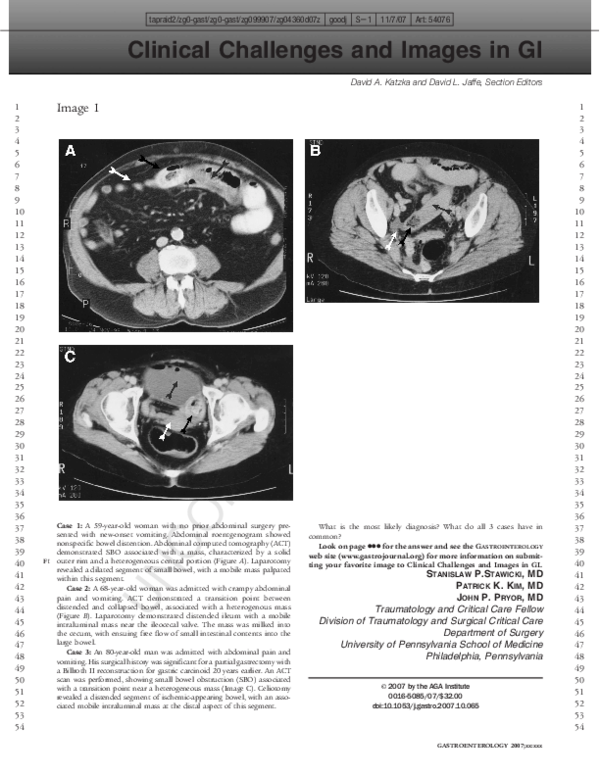 Menetrier's disease treatment picture