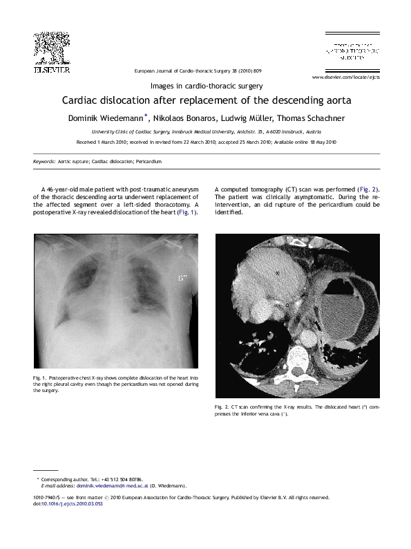 (PDF) Cardiac dislocation after replacement of the descending aorta