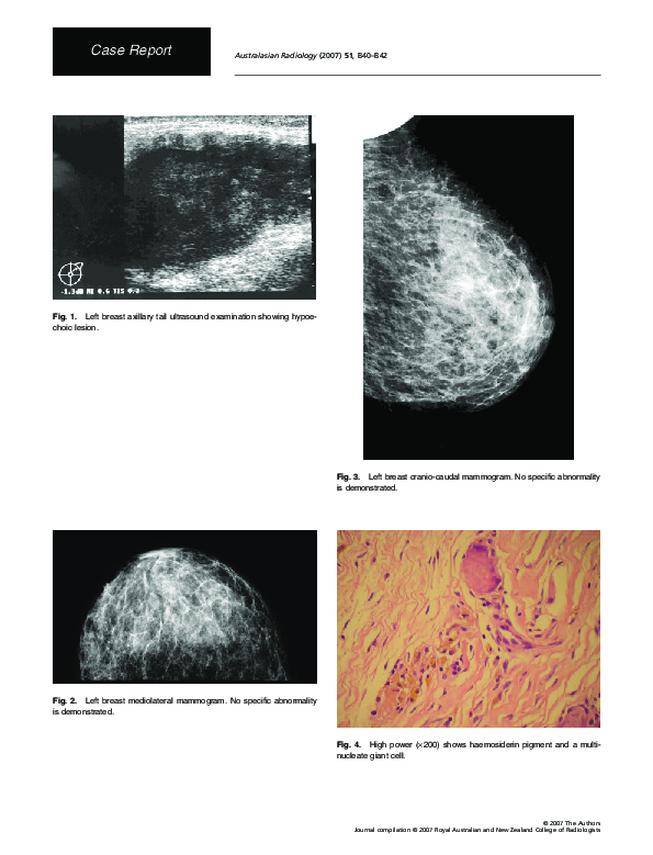 (PDF) Axillary lump an unusual presentation of fat necrosis in the