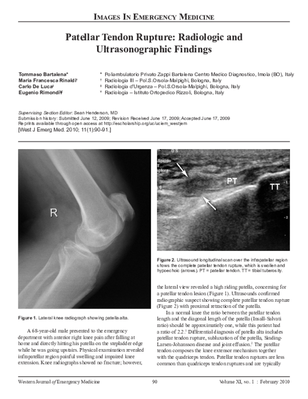 (PDF) Patellar Tendon Rupture: Radiologic and Ultrasonographic Findings
