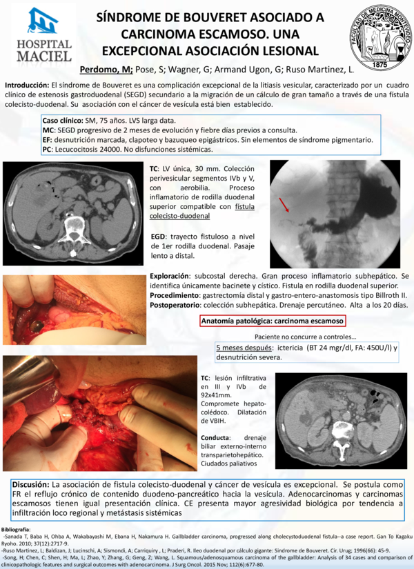 (PDF) SÍNDROME DE BOUVERET ASOCIADO A CARCINOMA DE VESÍCULA. REPORTE DE