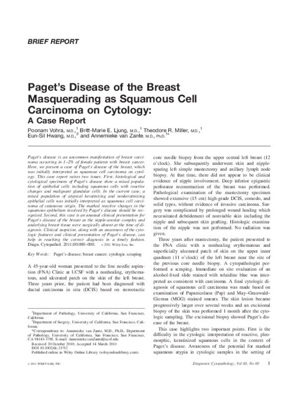 (PDF) Paget's disease of the breast masquerading as squamous cell carcinoma on cytology A case