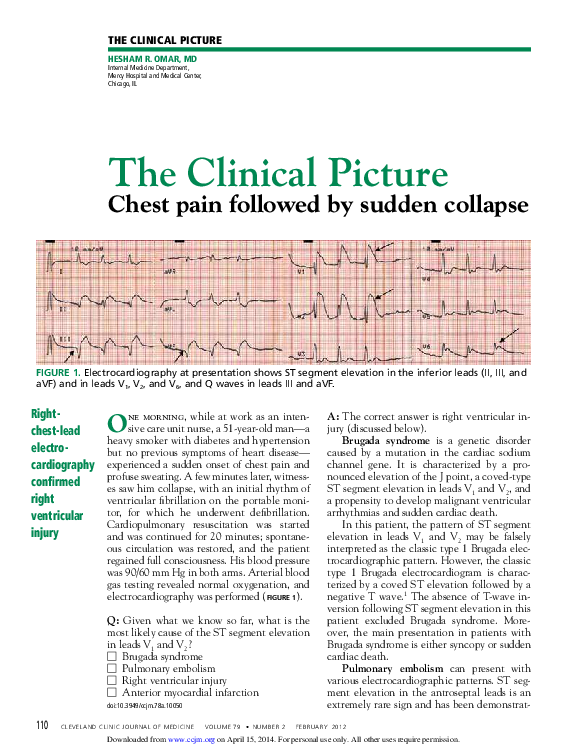 (PDF) Chest pain followed by sudden collapse