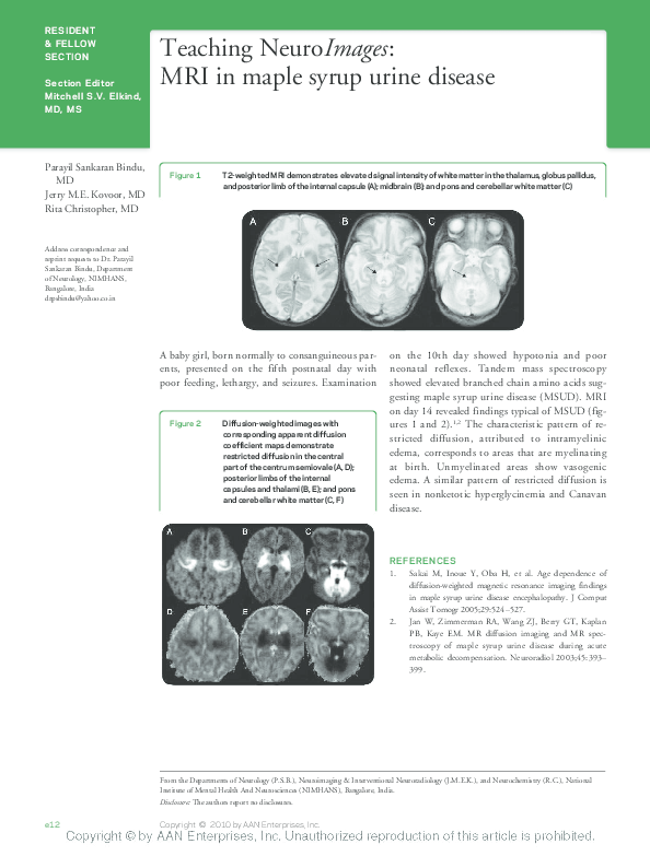 (PDF) Teaching NeuroImages: MRI in maple syrup urine disease