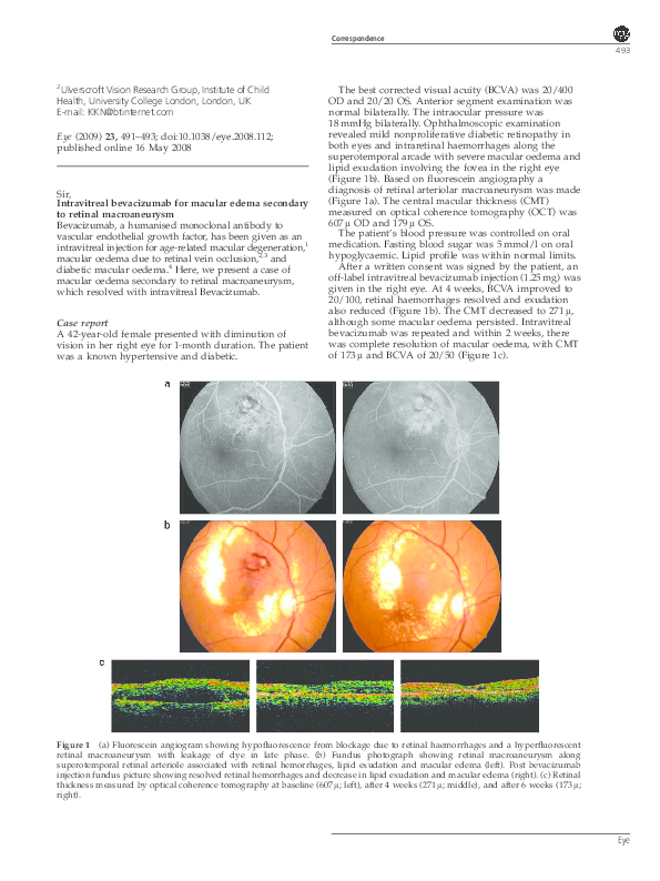 (PDF) Intravitreal bevacizumab for macular edema secondary to retinal ...