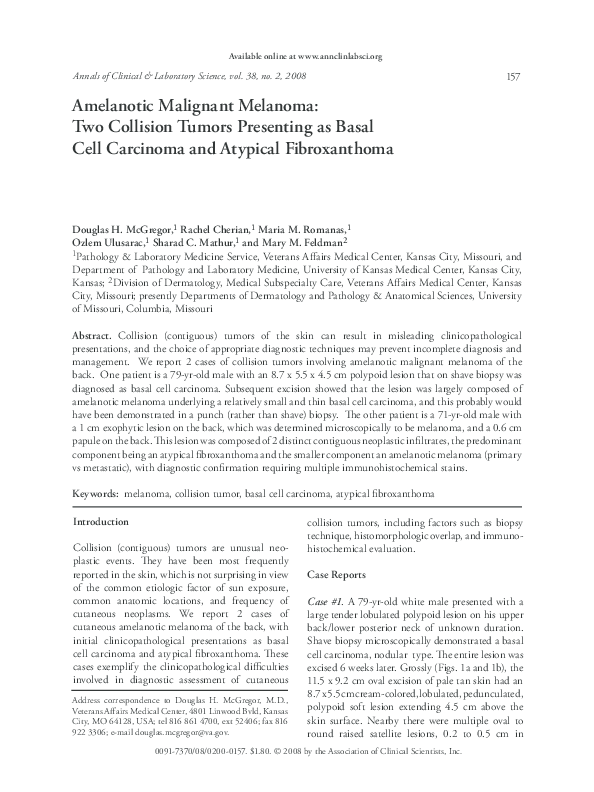 Pdf Amelanotic Malignant Melanoma Two Collision Tumors Presenting As Basal Cell Carcinoma And Atypical Fibroxanthoma Rachel Cherian Academia Edu