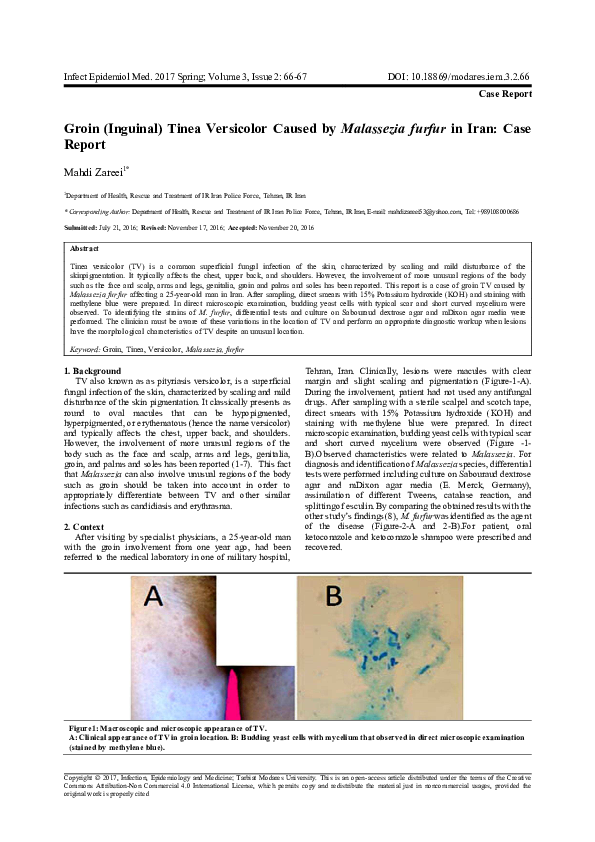 (PDF) Groin (Inguinal) Tinea Versicolor Caused by Malassezia furfur in Iran Case Report